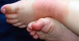 La Dermatitis Atopica Se Presenta En El 85 De Los Casos En El Primer Ano De Vida Mundodehoy Com
