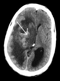 Image result for Brain Abscess