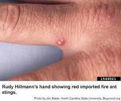 Image result for Fire Ant Sting