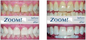 Check spelling or type a new query. Teeth Whitening Stourbridge Zoom Teeth Whitening Lion Dental Centre