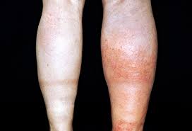 4 Blood Clot Symptoms Not To Ignore