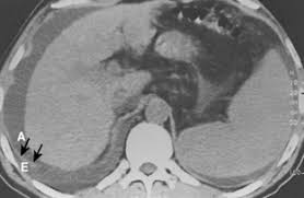In healthy lungs, these membranes ensure that a. The Pleura Radiology Key