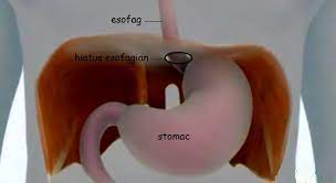 Hernia hiatala da simptome suparatoare. Hernia Hiatala Si Boala De Reflux Gastro Esofagian Medlife