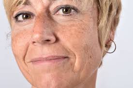 Naturliche Helfer Gegen Altersflecken Diese Sollten Sie Kennen