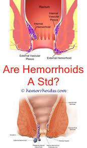 Check spelling or type a new query. Pin On How To Treat Hemorrhoids