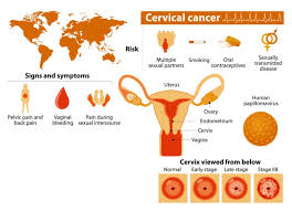 The most common warning signs of cervical cancer is untimely vaginal bleeding. Cervical Cancer Signs Of Cervical Cancer Kimaja Farwani