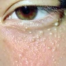 How To Get Rid Of Milia Under Eyes Whiteheads Remedies White Bumps On Face Bumps Under Eyes Homemade Wrinkle Cream