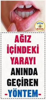 Agiz Ici Yaralara Cozum Olacak Dogal Yontemler Saglik Saglik Ve Fitness Saglikli Yasam Tarzi