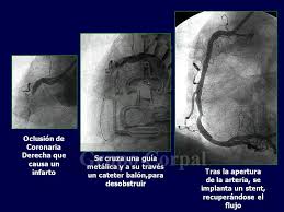 De una prolongada e irreversible isquemia miocárdica y. Cateterismo En Paciente Con Infarto Agudo De Miocardio Grupo Corpal