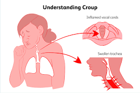 Symptoms Causes And Treatment Of Croup