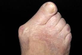 How to stop bunion pain. Bunions Nhs
