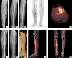 Image result for Osteomyelitis XRay