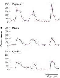 The sphincter of oddi is a muscular valve in your digestive tract. Investigation Of Sphincter Of Oddi Dysfunction Hpb