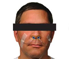 Long-Term Use of a Nasal Expiratory Positive Airway Pressure (EPAP) Device  as a Treatment for Obstructive Sleep Apnea (OSA)