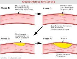 Triglyceride Erhoht Zu Hoch Was Nun