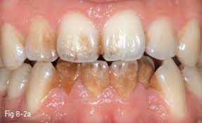 Tooth Discoloration Pocket Dentistry
