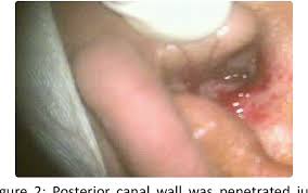A Rare Case Of Adenoid Cystic Carcinoma Of Ceruminous Gland Of Eac Semantic Scholar