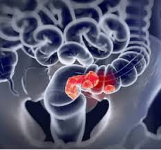 Change in bowel habits may be a sign of something externally pressing on the colon. Colon Cancer Symptoms Causes Treatment Meril Life