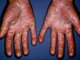 Maybe you would like to learn more about one of these? Pityriasis Rubra Pilaris Dermatly Com Ihre Hautseite