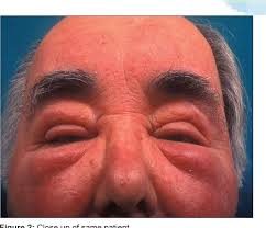 4 clinical examination typically reveals firm, nonpitting edema and erythema, particularly of the forehead, glabella, eyelids, nose, and cheeks. Pdf Morbihan Syndrome Semantic Scholar