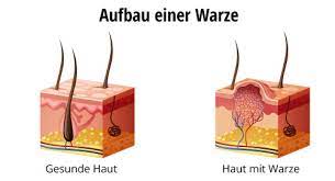 Warzen Welche Arten Gibt Es Bodfeld Apotheke Blog