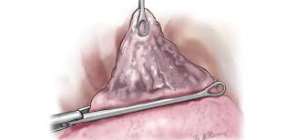 These are not alone the bones, which held the. Pulmonary Blebs And Bullae