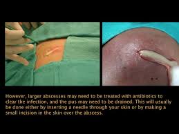Image result for Skin Abscess