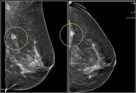 Check spelling or type a new query. False Mammograms Are More Common Than You Think Dennis R Holmes M D F A C S Breast Cancer Surgeon
