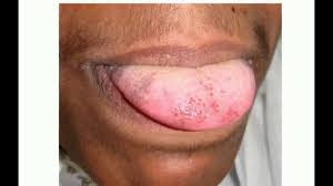 The appearance may be alarming, but it is a harmless condition. Black Hairy Tongue Youtube