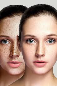 Pigmentation Treatment in Birmingham