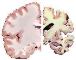 Det viktigste kjennetegnet på demenssykdom er hukommelsessvikt. Alzheimers Sykdom Store Medisinske Leksikon