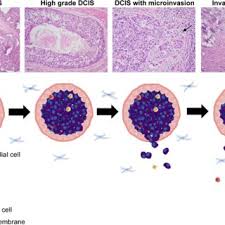 Bowen disease, which is also known as squamous cell carcinoma in situ, typically arises as a result of sun exposure. How Did We Get There The Progression From Ductal Carcinoma In Situ To Invasive Ductal Carcinoma Request Pdf