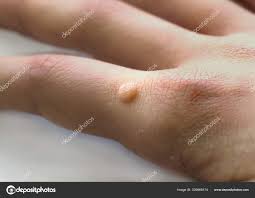 Image result for verrucae filiformes