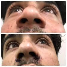 If your polyps don't yield to steroids, you may be recommended for surgery. Rhinoplasty Cost In Pakistan Lahore Cosmetic Nose Job Surgery