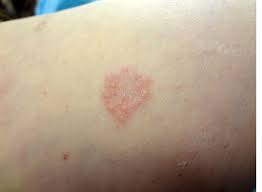 Granuloma annulare pictures children faces. Granuloma Annulare Treatment Granuloma Annulare Pictures Granuloma Annulare Causes Granuloma Symptoms