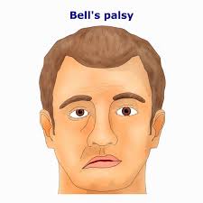 It's believed to be the result of swelling and inflammation of the nerve that. Bell S Palsy And Their Symptoms Causes Risk Factors Diagnosis Tests Treatment And Drugs And Complications Of Bell S Palsy Genes Com Pk