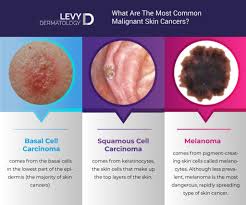 Read more to understand the difference between cancerous tumors and what you should be concerned about. Most Common Malignant Skin Cancers Detect Skin Cancer Memphis Levy Dermatology
