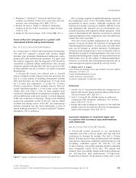 Successful treatment of recalcitrant malar rash in a patient with cutaneous  lupus erythematosus with efalizumab