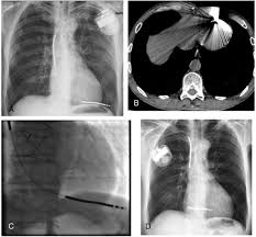 37.71 initial insertion of transvenous lead (electrode) into ventricle 02hk3jz insertion of pacemaker lead into right ventricle, percutaneous approach 37.72 initial insertion of transvenous leads (electrodes). Beeping Icd Device Case Report Sciencedirect