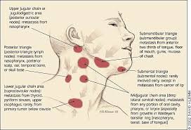 A large number of lymph nodes are linked throughout the body by the lymphatic vessels. Lymph Nodes Oh Allergies And Chronic Ear Infections Swollen Lymph Nodes Lymph Nodes Lymph Massage