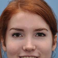 Brow Lift Surgery Dallas-Fort Worth Texas