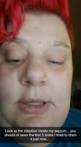 if yall could tag @dr.pimplepopperofficial and try to help get her  attention so I could get some help lol #pimple #abcess #septumpiercing #fyp