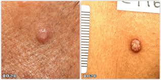 Skin cancer is becoming more and more common, if you're worried about getting skin cancer, check out these 20 skin cancer symptoms everyone when squamous cell carcinoma doesn't develop into a lump, it appears as more of a reddish patch. Mimics Of Skin Cancer Ii Skin Cancer 909