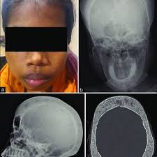 A) T1-weighted sagittal section of thoracic spine showing a large,...