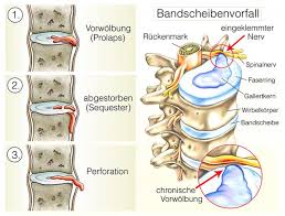 Was tun bei einem bandscheibenvorfall? Inkontinenz Durch Bandscheibenvorfall Kontinenzzentrum Hirslanden