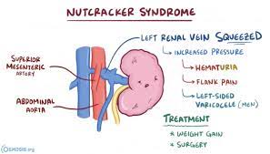 Keith Siau On Twitter The Superior Mesenteric Artery Sma Can Result In 2 Compression Syndromes Meded 1 Sma Syndrome Duodenal D3 Compression 2 Nutcracker Syndrome Renal Vein Compression Https T Co Utnxcf0ay4 Https T Co 4u8qlayav3