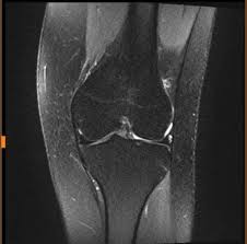 Mrt vom knie in der radiologie 360°. Kennt Sich Jemand Mit Mrt Bildern Aus Knie Gesundheit Und Medizin Arthrose Radiologie