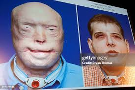 16 Langone Medical Center Announces Most Extensive Face Transplant In  History Stock Photos, High-Res Pictures, and Images