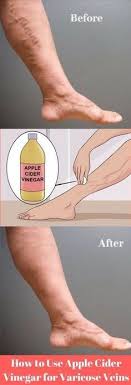 Pin On Apple Cider Vinegar