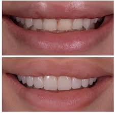 Veneers Made In Hamburg Quarree Dental